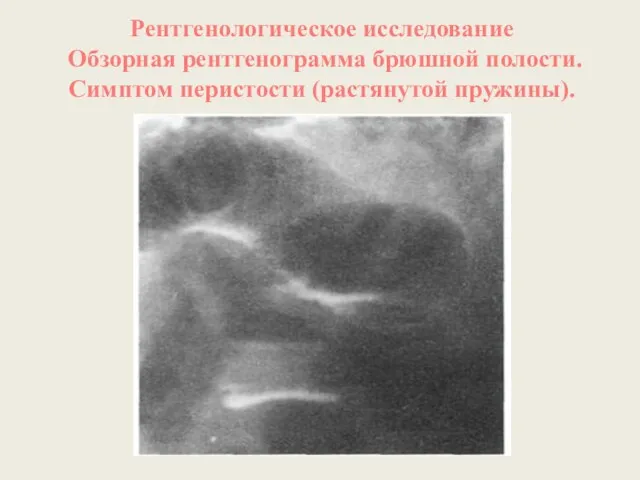 Рентгенологическое исследование Обзорная рентгенограмма брюшной полости. Симптом перистости (растянутой пружины).