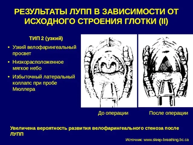 РЕЗУЛЬТАТЫ ЛУПП В ЗАВИСИМОСТИ ОТ ИСХОДНОГО СТРОЕНИЯ ГЛОТКИ (II) ТИП