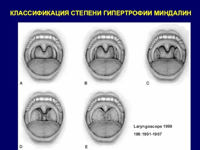КЛАССИФИКАЦИЯ СТЕПЕНИ ГИПЕРТРОФИИ МИНДАЛИН Laryngoscope 1999 109:1901-1907