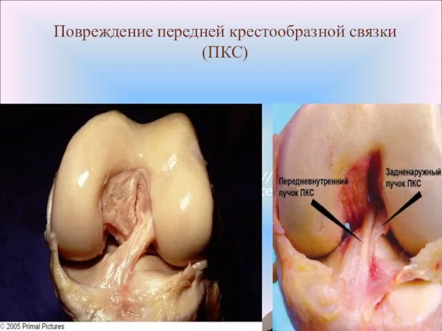 Повреждение передней крестообразной связки (ПКС) Mandelbaum B. Preventing ACL injures