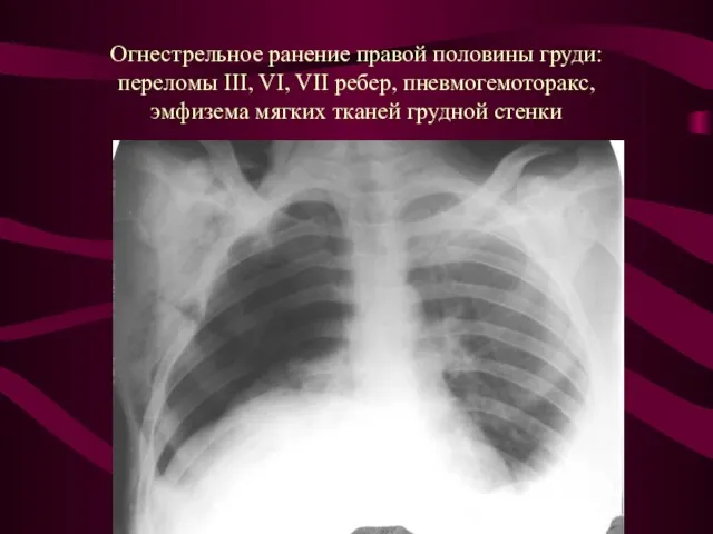Огнестрельное ранение правой половины груди: переломы III, VI, VII ребер, пневмогемоторакс, эмфизема мягких тканей грудной стенки