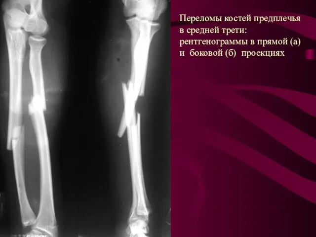 Переломы костей предплечья в средней трети: рентгенограммы в прямой (а) и боковой (б) проекциях