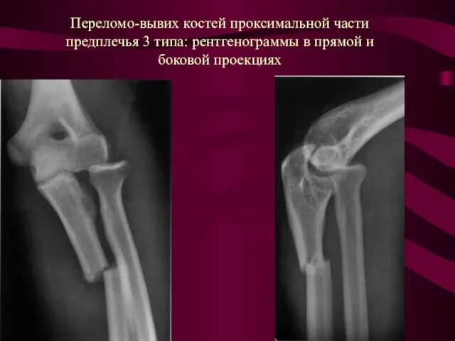 Переломо-вывих костей проксимальной части предплечья 3 типа: рентгенограммы в прямой и боковой проекциях
