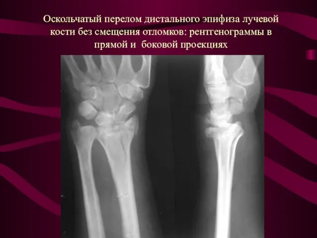 Оскольчатый перелом дистального эпифиза лучевой кости без смещения отломков: рентгенограммы в прямой и боковой проекциях