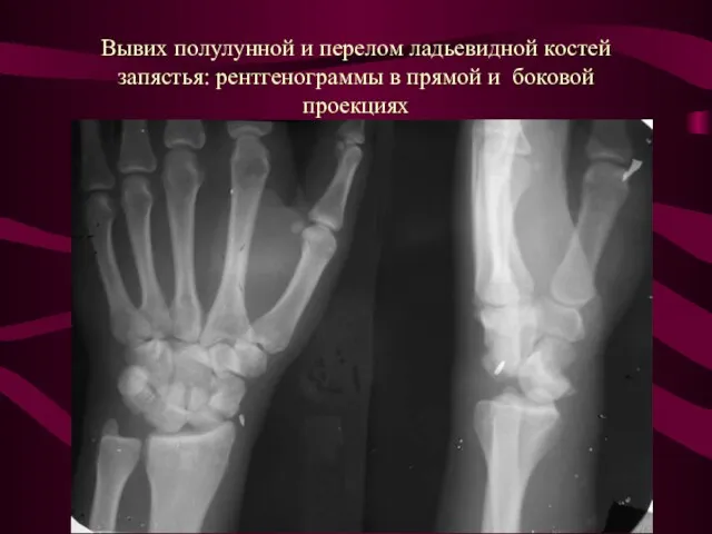 Вывих полулунной и перелом ладьевидной костей запястья: рентгенограммы в прямой и боковой проекциях