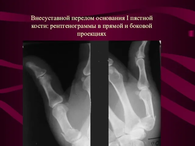 Внесуставной перелом основания I пястной кости: рентгенограммы в прямой и боковой проекциях