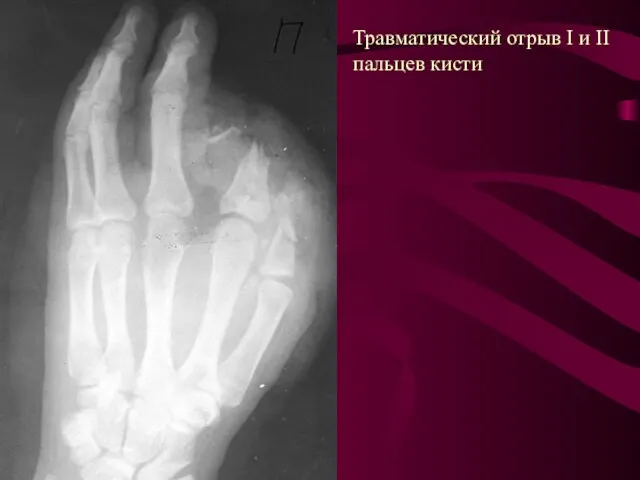 Травматический отрыв I и II пальцев кисти