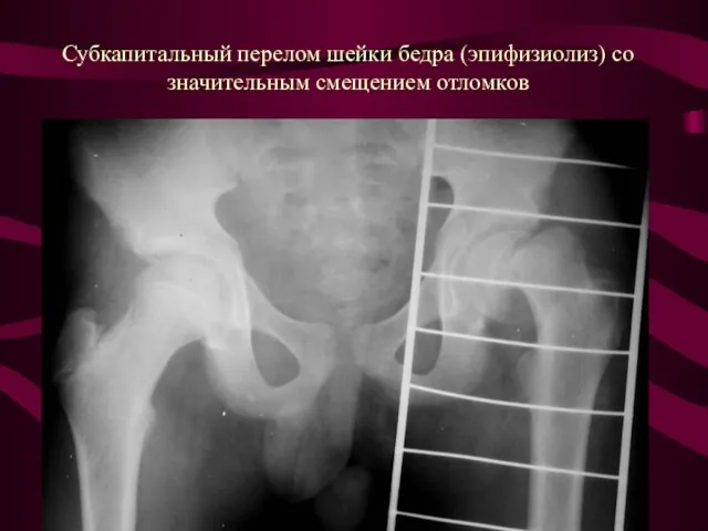 Субкапитальный перелом шейки бедра (эпифизиолиз) со значительным смещением отломков