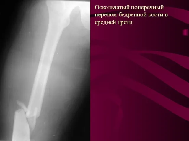 Оскольчатый поперечный перелом бедренной кости в средней трети