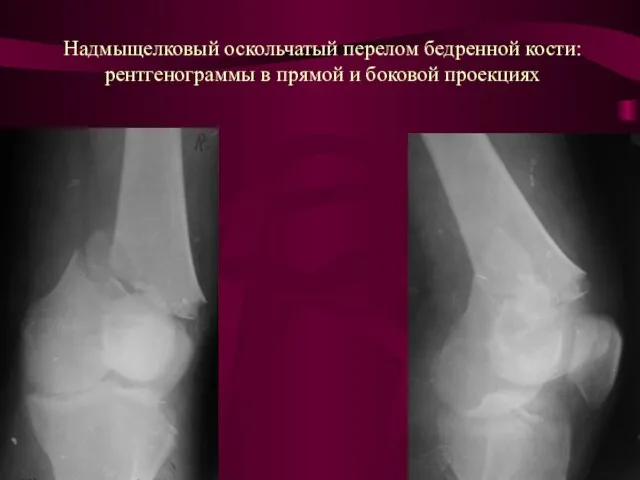 Надмыщелковый оскольчатый перелом бедренной кости: рентгенограммы в прямой и боковой проекциях