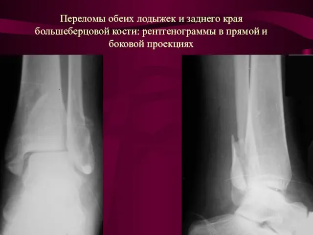 Переломы обеих лодыжек и заднего края большеберцовой кости: рентгенограммы в прямой и боковой проекциях