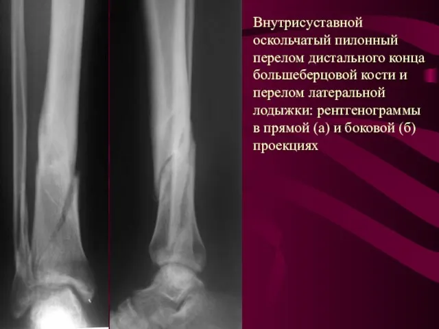 Внутрисуставной оскольчатый пилонный перелом дистального конца большеберцовой кости и перелом латеральной лодыжки: рентгенограммы