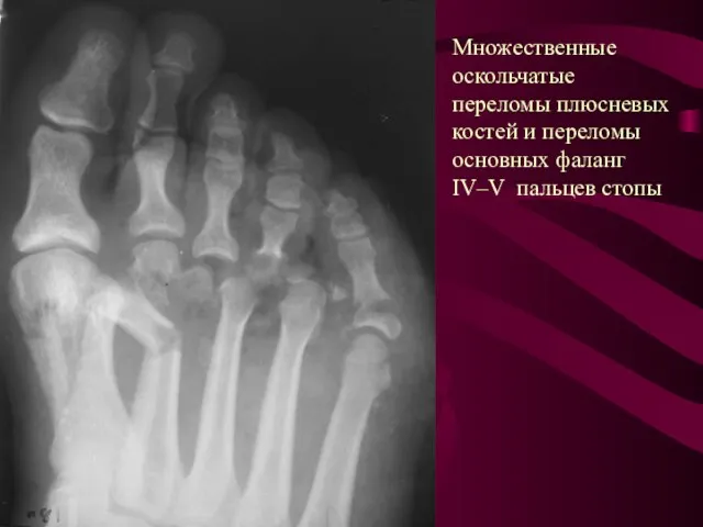 Множественные оскольчатые переломы плюсневых костей и переломы основных фаланг IV–V пальцев стопы