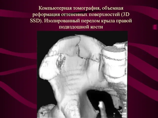 Компьютерная томография, объемная реформация оттененных поверхностей (3D SSD). Изолированный перелом крыла правой подвздошной кости