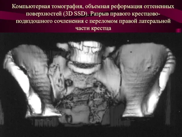 Компьютерная томография, объемная реформация оттененных поверхностей (3D SSD). Разрыв правого крестцово-подвздошного сочленения с