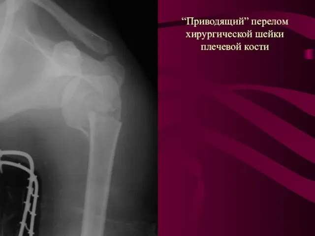 “Приводящий” перелом хирургической шейки плечевой кости