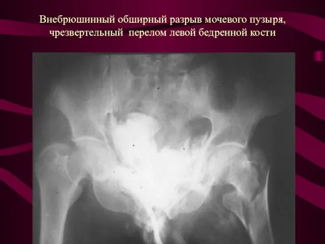 Внебрюшинный обширный разрыв мочевого пузыря, чрезвертельный перелом левой бедренной кости