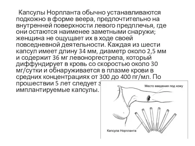 Капсулы Норпланта обычно устанавливаются подкожно в форме веера, предпочтительно на