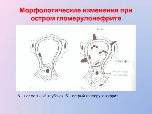 Морфологические изменения при остром гломерулонефрите А – нормальный клубочек. Б – острый гломерулонефрит.