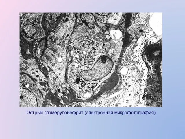 Острый гломерулонефрит (электронная микрофотография)