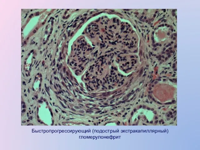 Быстропрогрессирующий (подострый экстракапиллярный) гломерулонефрит