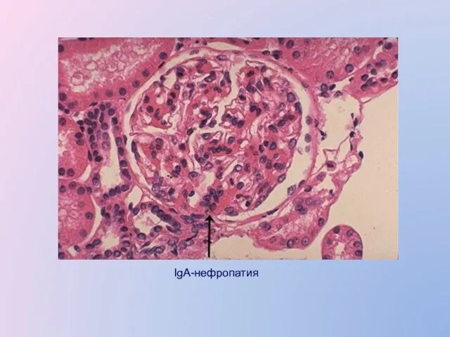IgA-нефропатия
