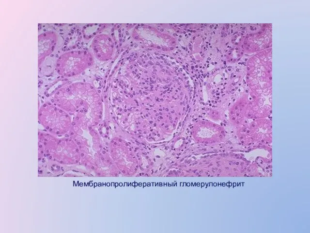 Мембранопролиферативный гломерулонефрит