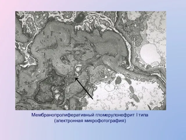 Мембранопролиферативный гломерулонефрит I типа (электронная микрофотография)