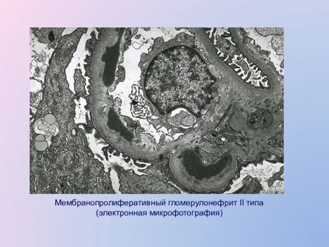 Мембранопролиферативный гломерулонефрит II типа (электронная микрофотография)