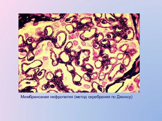 Мембранозная нефропатия (метод серебрения по Джонсу)