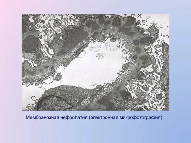 Мембранозная нефропатия (электронная микрофотография)