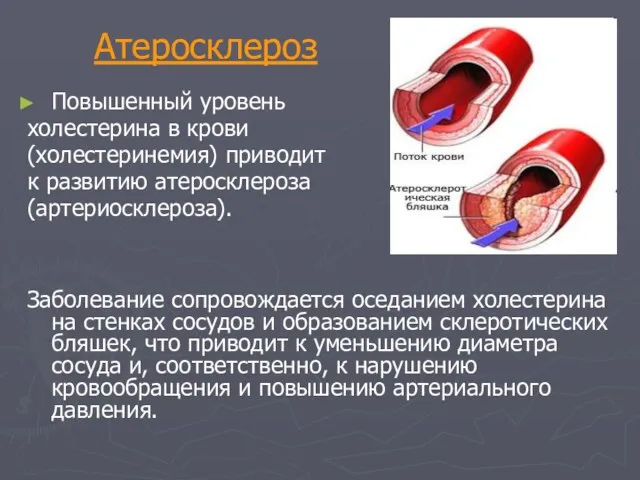 Атеросклероз Повышенный уровень холестерина в крови (холестеринемия) приводит к развитию