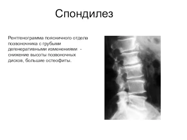 Спондилез Рентгенограмма поясничного отдела позвоночника с грубыми дегенеративными изменениями - снижение высоты позвоночных дисков, большие остеофиты.