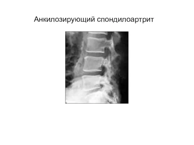 Анкилозирующий спондилоартрит