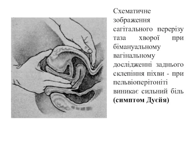 Схематичне зображення сагітального перерізу таза хворої при бімануальному вагінальному дослідженні
