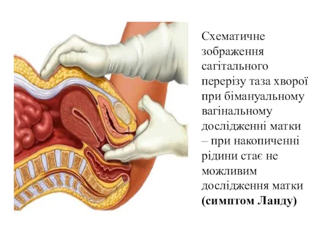 Схематичне зображення сагітального перерізу таза хворої при бімануальному вагінальному дослідженні