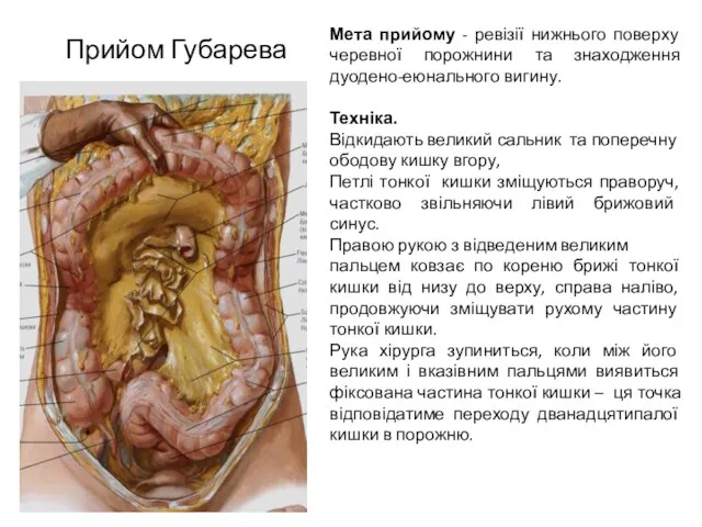 Прийом Губарева Мета прийому - ревізії нижнього поверху черевної порожнини