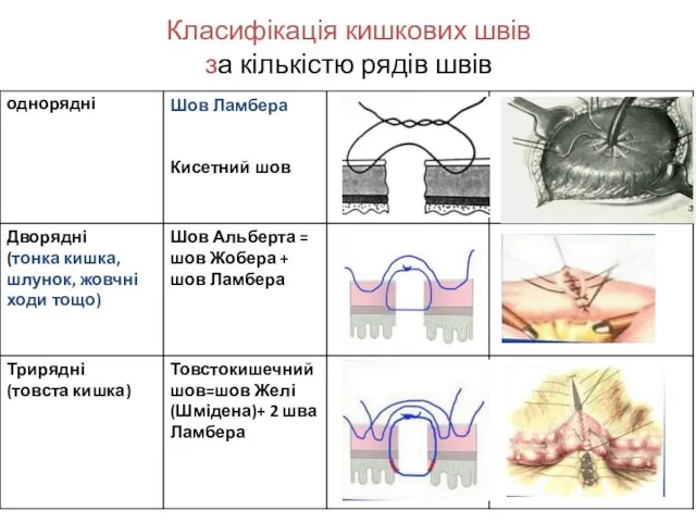 Класифікація кишкових швів за кількістю рядів швів :