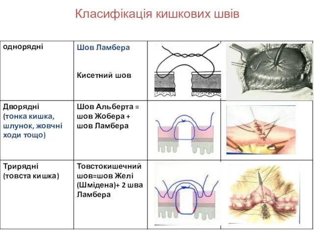 Класифікація кишкових швів :