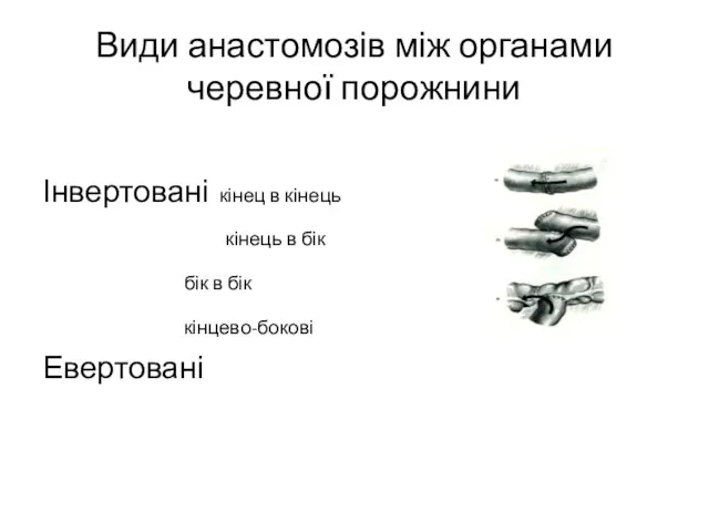 Види анастомозів між органами черевної порожнини Інвертовані кінец в кінець