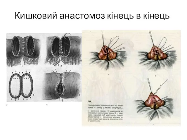 Кишковий анастомоз кінець в кінець