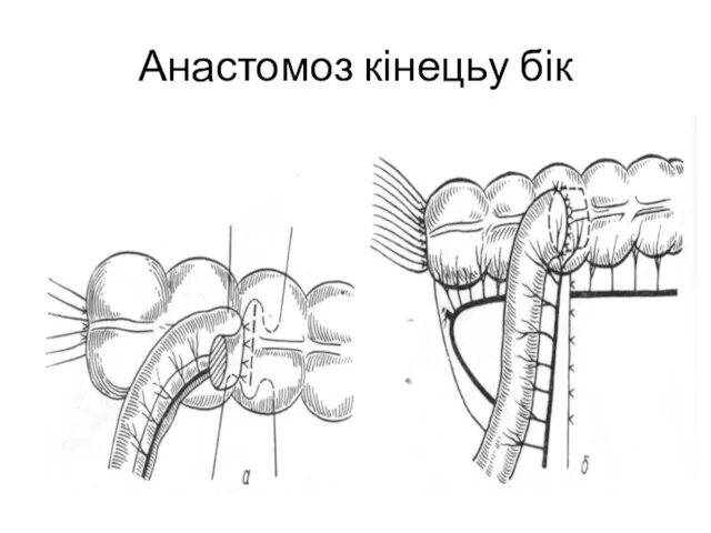 Анастомоз кінецьу бік