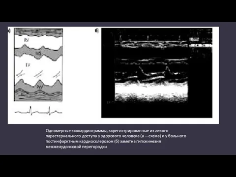 Одномерные эхокардиограммы, зарегистрированные из левого парастернального доступа у здорового человека