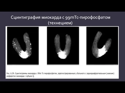 Сцинтиграфия миокарда с 99mТс-пирофосфатом (технецием)