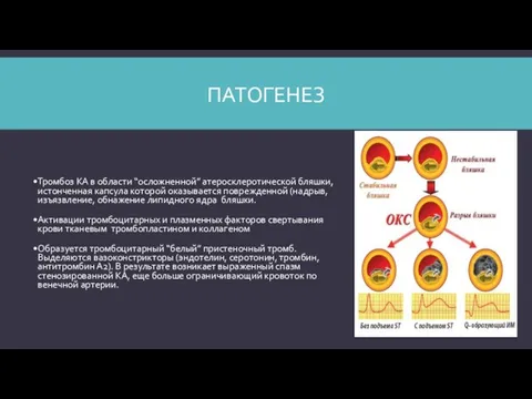 ПАТОГЕНЕЗ Тромбоз КА в области “осложненной” атеросклеротической бляшки, истонченная капсула