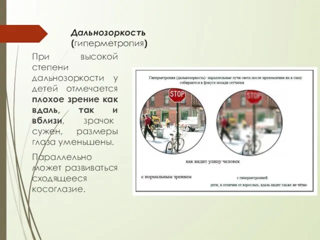 Дальнозоркость (гиперметропия) При высокой степени дальнозоркости у детей отмечается плохое зрение как вдаль,