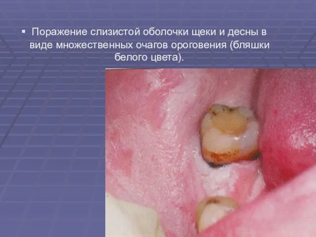 Поражение слизистой оболочки щеки и десны в виде множественных очагов ороговения (бляшки белого цвета).