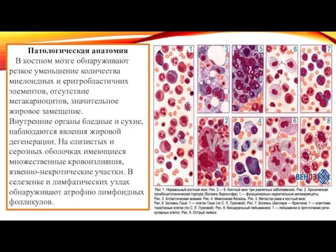 Патологическая анатомия В костном мозге обнаруживают резкое уменьшение количества миелоидных