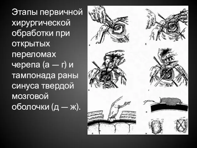 Этапы первичной хирургической обработки при открытых переломах черепа (а —