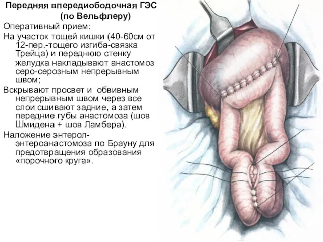 Передняя впередиободочная ГЭС (по Вельфлеру) Оперативный прием: На участок тощей кишки (40-60см от